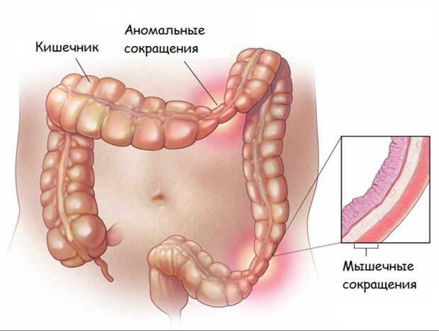 Врач-гастроэнтеролог: синдром раздраженного кишечника - что это такое?