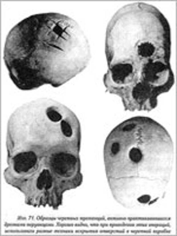 Операции по трепанации черепа у древних инков