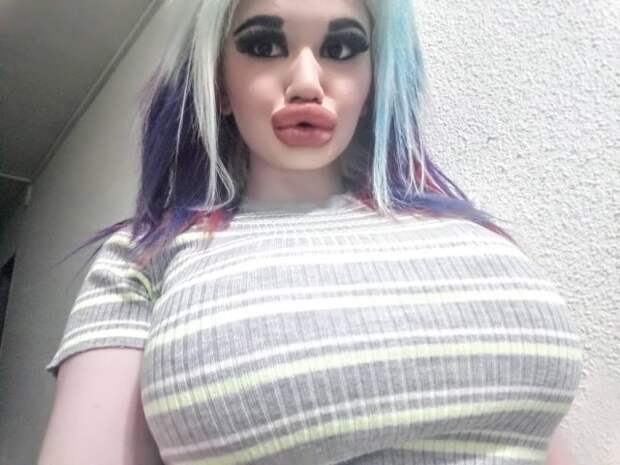 Девушка из Болгарии с самыми большими в мире губами провела 20-ю процедуру по их увеличению