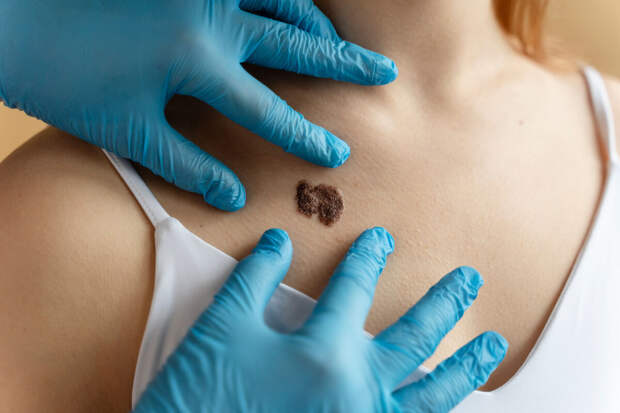 AdvMaterials: пластырь с микроиглами помогает выявлять рак кожи на ранней стадии