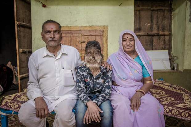 13-летний индийский мальчик с синдромом оборотня