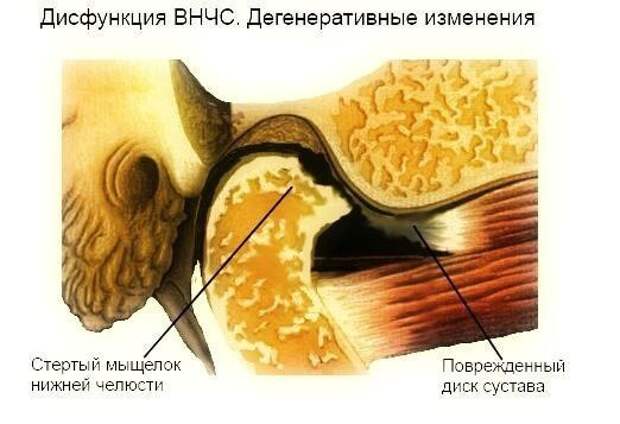 Лечение дисфункций височно-нижнечелюстного сустава