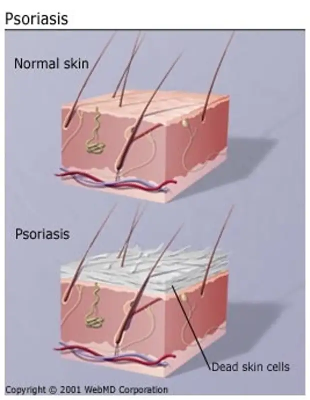 Psoriasis Porn