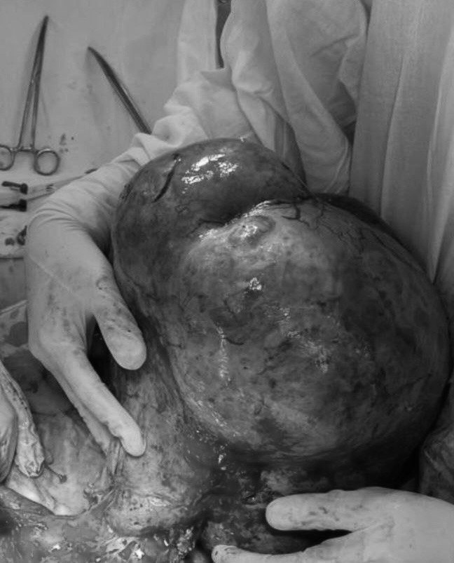 Врачи прооперировали 71-летнюю пациентку с гигантской опухолью весом 7 кг и 45 см в диаметре, занимавшую большую часть брюшной полости. Выяснилось, что увеличение размеров живота и появление кровянистых выделений женщина заметила ещё в марте этого года. И только спустя четыре месяца её по «скорой» доставили в больницу из-за резких болей в животе. Врачи выставили диагноз «опухоль яичников». Патология крайне опасна для жизни и здоровья тем, что может привести к разрыву, внутрибрюшному кровотечению и летальному исходу, поэтому онкохирурги решили оперировать пациентку.