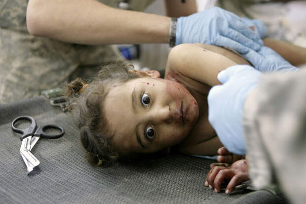 Раненая иракская девочка