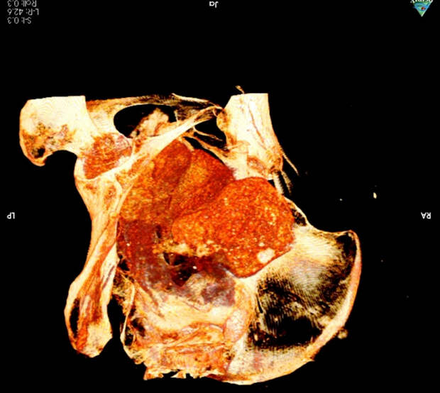 КТ тазовой области мумии. 