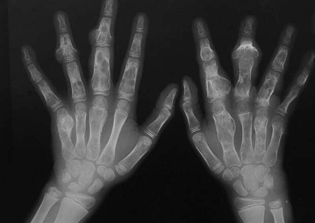 Что такое хондрома? Причины, симптомы, диагностика и лечение