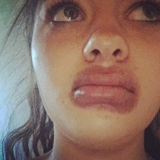 19-летняя ростовчанка попыталась увеличить губы пылесосом губы, пылесос
