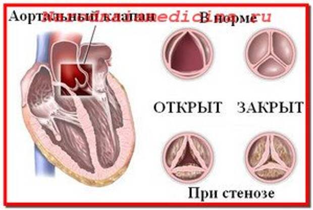 Аортальный стеноз. Лечение народными средствами и консервативное