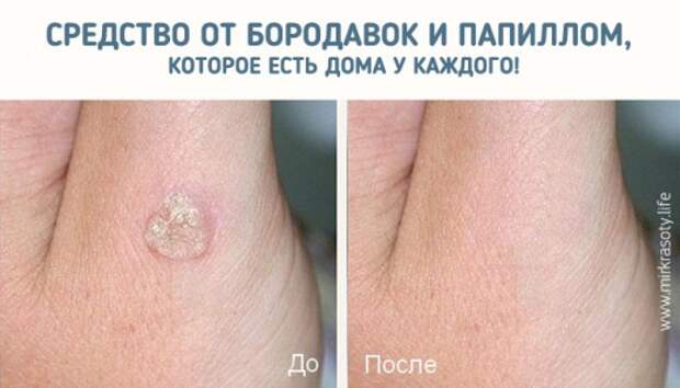 Через 5 дней от папиллом и бородавок не останется и следа…