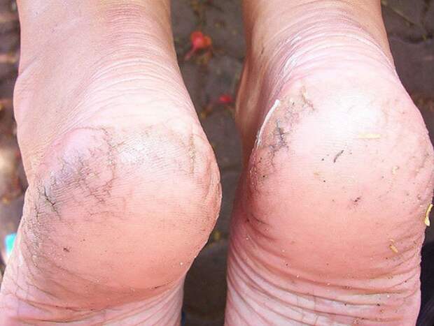 cracked-heels-610x460