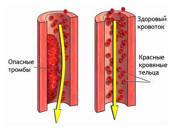 Картинки по запросу тромбы в сосудах