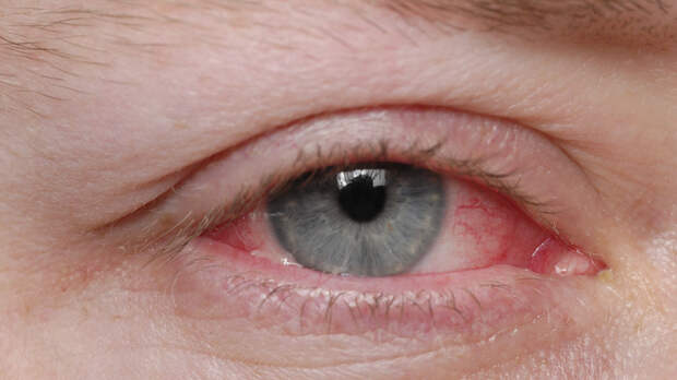 Офтальмолог Зарубин: зимний воздух может спровоцировать конъюнктивит