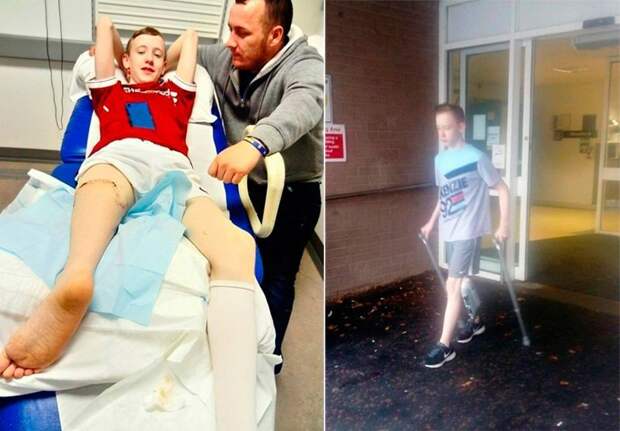 Хирурги пришили ребенку ногу задом наперед, чтобы он мог играть в футбол в мире, люди, нога, спорт, футбол, хирург