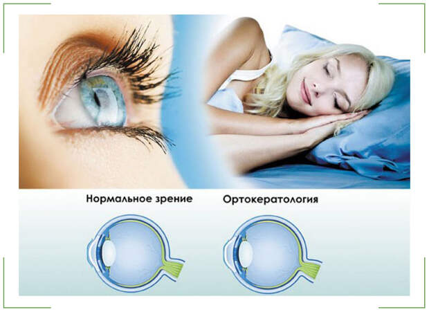 Ортокератологические линзы – корректирующие линзы нового поколения