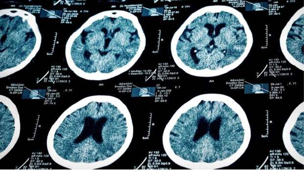 То, что травмы головного мозга ведут к изменениям характера, было известно ученым давно
