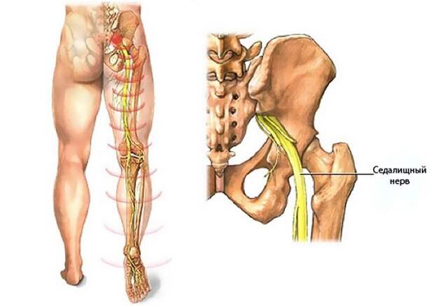 устранение и лечение воспаления седалищного нерва