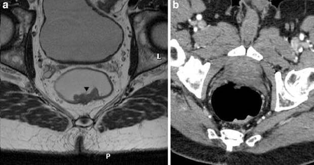 Анальный рак. Внутрибрюшинного разрыва прямой кишки. Повреждение прямой кишки.