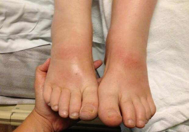 Картинки по запросу аллергия отеки ноги