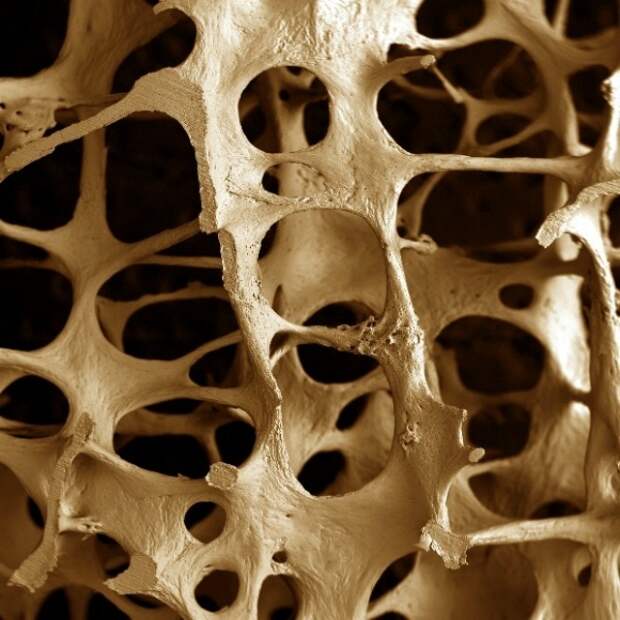 Картинки по запросу остеопороз костей