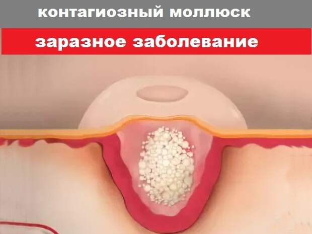 Прорыв в дерматологии: первое лекарство от контагиозного моллюска. История, наука и надежда для миллионов