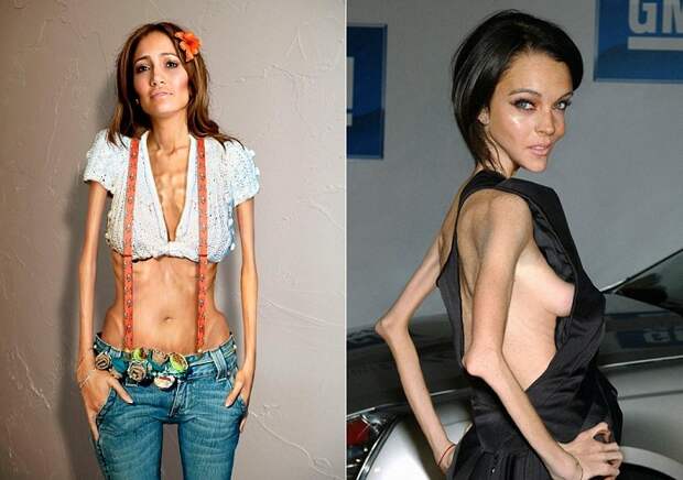 Anorexic Celebrities - серия фотожаб голливудских селебритис.