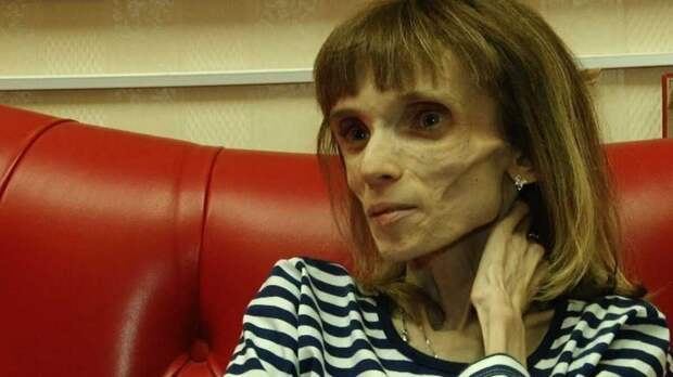Что стало с Кристиной Колягиной из Барнаула, которая 8 лет назад весила 17 кг