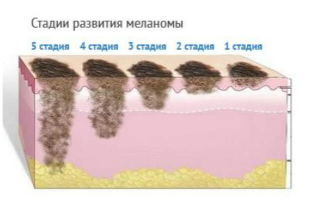 Если на вашей коже есть место, которое вас беспокоит, лучше сразу обратиться к врачу. Также вам не помешает иметь представление о том, какую родинку можно считать “тревожной”. Знание того, как выглядит меланома, может спасти вашу жизнь! РОДИНКИ, важное, детектор, здоровые, интересное, меланома, рак кожи