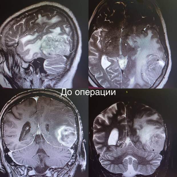В Мелитопольскую областную была доставлена пациентка, которую беспокоили жалобы на головные боли, головокружения, снижение памяти и дезориентацию. Проведено МРТ обследование, установлено наличие объемного образования головного мозга затылочной доли слева. Врачами принято решение неотложно провести хирургическое вмешательство. Опухоль максимально удалили. По словам оперирующего нейрохирурга Михаила Еремеева, сложность операции заключалась в ее радикальности: