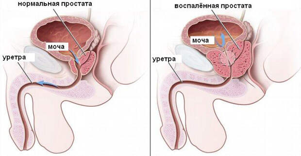 Методы остеопрактики при простатите