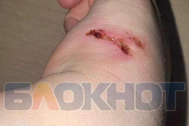 "Блокнот": в Воронежской области собаки искусали беременную девушку