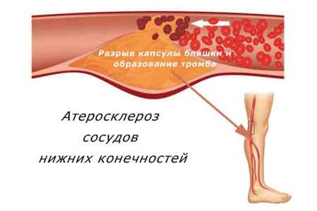 атеросклероз артерий нижних конечностей