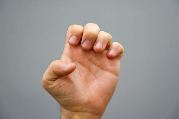 Смертельная опасность под ногтем: как отличить синяк от подногтевой меланомы