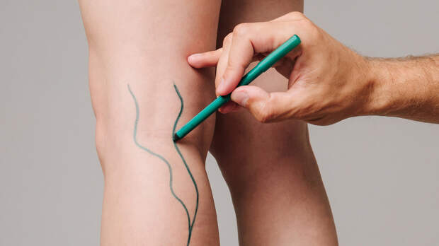 Хирург Умнов: распознать тромбофлебит можно при появлении асимметрии ног