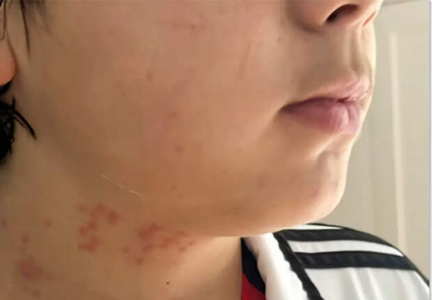 Семья из США подала в суд на авиакомпанию KLM за рейс с клопами