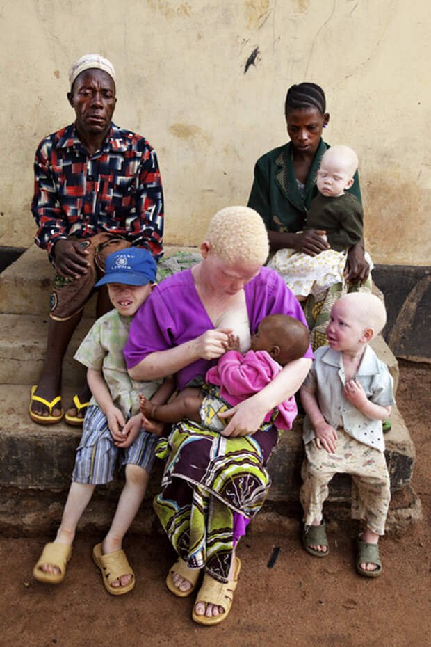 За что альбиносов в Танзании рубят на куски? 