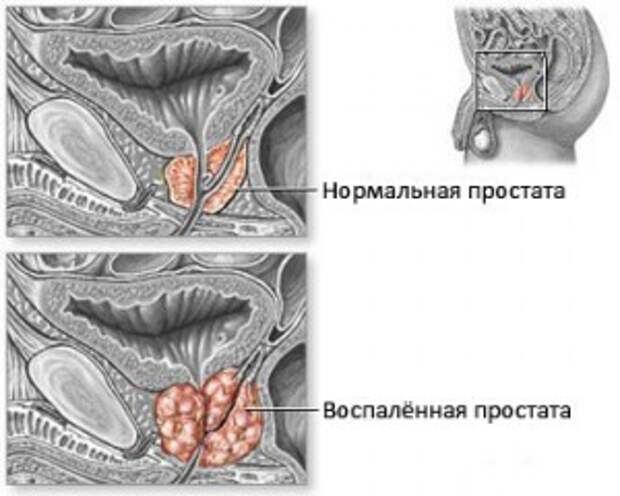 простатит