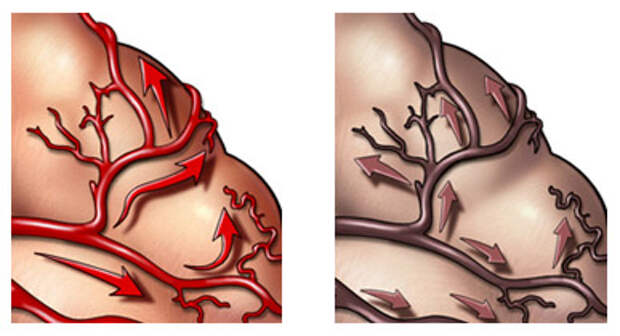 Нарушение мозгового кровообращения при сосудистой деменции