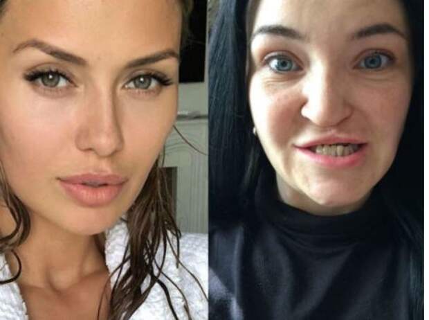Заячья губа у знаменитостей фото до и после операции россии
