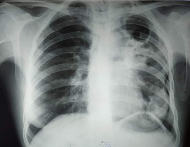 Обзорная рентгенограмма органов грудной клетки. Фиброзно-кавернозный туберкулёз лёгких. В верхних отделах слева визуализируется каверна.