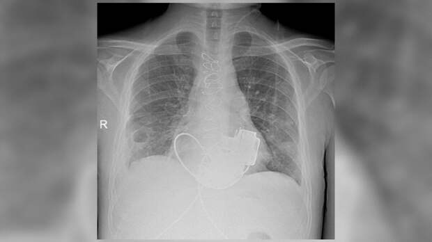 Единственного в стране пациента без пульса выпишут из Мариинской больницы