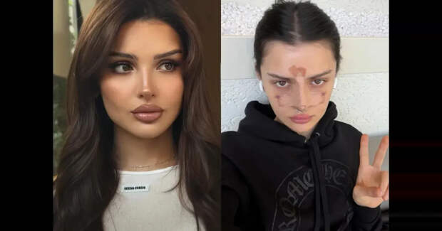 Дина Саева перенесла операцию на носу