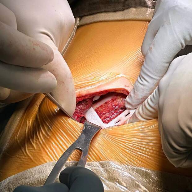 В ФГБУ «Национальный медицинский исследовательский центр фтизиопульмонологии и инфекционных заболеваний» Минздрава России обратилась женщина с жалобами на выпячивание в области грудной клетки при дыхании и кашле. Подробности узнала «Медицинская Россия». Симптомы появились спустя несколько лет после удаления 4-го ребра слева из-за доброкачественной опухоли. Со временем жалобы усиливались и начали приносить ей дискомфорт.