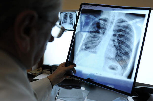 Врач Русакова: число умерших от туберкулеза за 10 лет уменьшилось почти на 70%