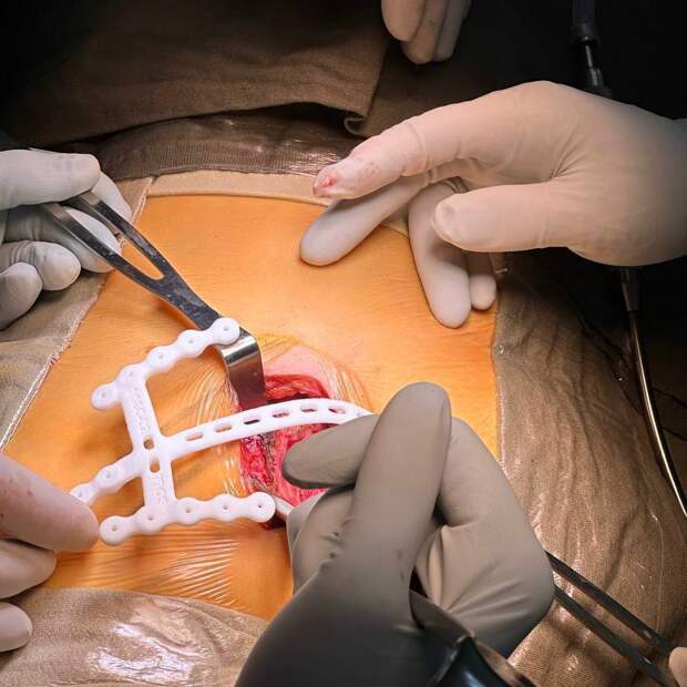 В ФГБУ «Национальный медицинский исследовательский центр фтизиопульмонологии и инфекционных заболеваний» Минздрава России обратилась женщина с жалобами на выпячивание в области грудной клетки при дыхании и кашле. Подробности узнала «Медицинская Россия». Симптомы появились спустя несколько лет после удаления 4-го ребра слева из-за доброкачественной опухоли. Со временем жалобы усиливались и начали приносить ей дискомфорт.