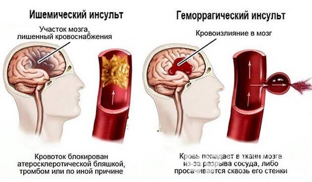 Сколько лежат в больнице с инсультом? Лечение и особенности восстановительного периода