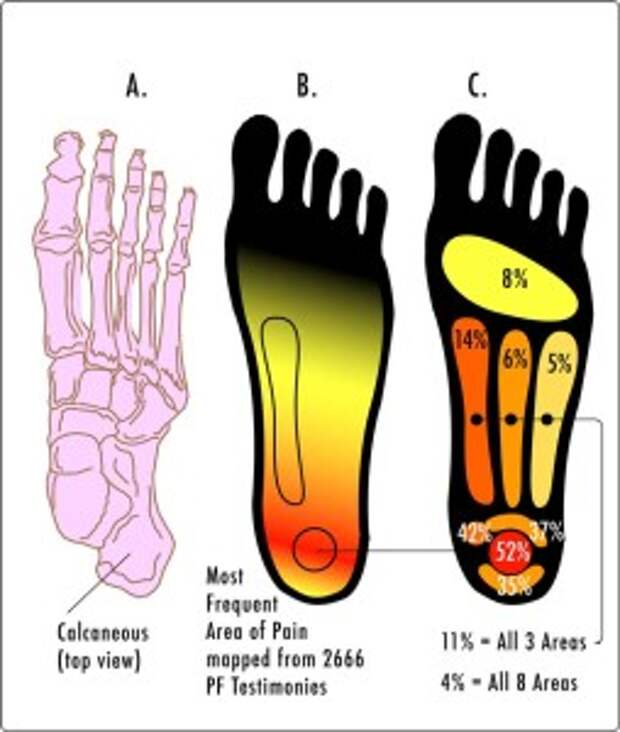 PF-PainAreas