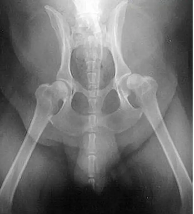 Патология тазобедренного сустава. Вывих шейки бедренной кости. Варусная деформация бедренных суставов. Варусная деформация тазобедренного сустава рентген. Дисплазия бедренной кости.