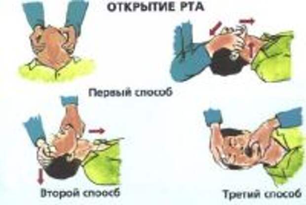 Способ открытия. Способы открывания рта пострадавшему. Открытие рта пострадавшего. Методы раскрытия рта пострадавшему. Методы открывания рта при реанимации.