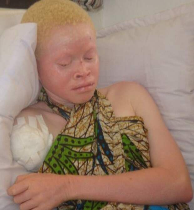 В Африке альбиносов разделывают на куски.